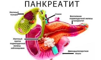 Панкреатит: симптомы, причины, диагностика, лечение и осложнения